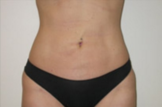 Liposuction Before & After Patient #1094