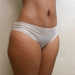 Liposuction Before & After Patient #1098