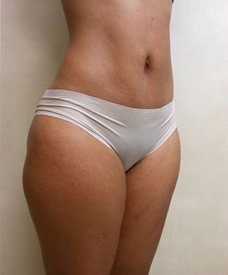 Liposuction Before & After Patient #1098