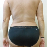 Liposuction Before & After Patient #1101