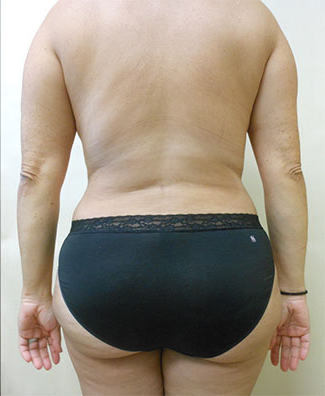 Liposuction Before & After Patient #1101