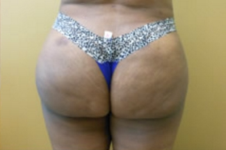 Brazilian Butt Lift Before & After Patient #1139