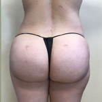 Brazilian Butt Lift Before & After Patient #1185