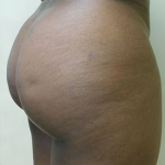 Brazilian Butt Lift Before & After Patient #1187