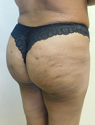 Brazilian Butt Lift Before & After Patient #1188