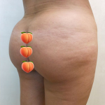 Brazilian Butt Lift Before & After Patient #1190