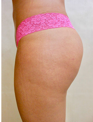 Brazilian Butt Lift Before & After Patient #1224