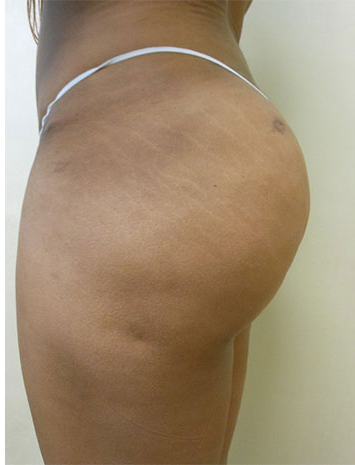Brazilian Butt Lift Before & After Patient #1223