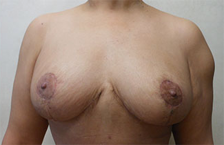 Breast Lift Before & After Patient #432