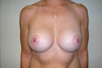 Breast Lift With Augmentation Before & After Patient #465