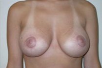 Breast Lift With Augmentation Before & After Patient #466