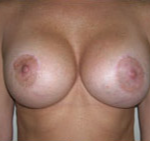 Breast Lift With Augmentation Before & After Patient #501