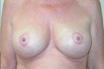 Breast Lift With Augmentation Before & After Patient #502