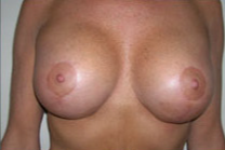 Breast Lift With Augmentation Before & After Patient #503