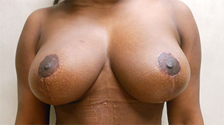 Breast Reduction Before & After Patient #533