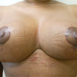 Breast Reduction Before & After Patient #534