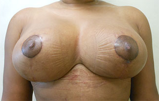 Breast Reduction Before & After Patient #534