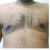 Gynecomastia Before & After Patient #549