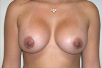 Breast Augmentation Before & After Patient #370
