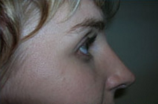 Rhinoplasty Before & After Patient #668
