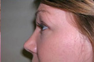 Rhinoplasty Before & After Patient #669