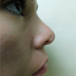 Rhinoplasty Before & After Patient #672