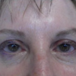 Blepharoplasty Before & After Patient #702