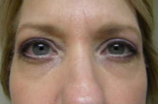 Blepharoplasty Before & After Patient #703