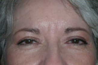 Blepharoplasty Before & After Patient #704