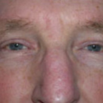Blepharoplasty Before & After Patient #706