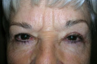 Blepharoplasty Before & After Patient #705