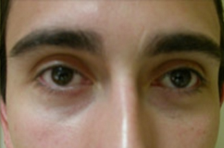 Blepharoplasty Before & After Patient #735