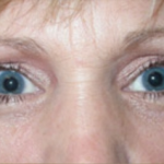 Blepharoplasty Before & After Patient #736