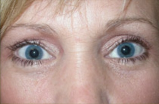 Blepharoplasty Before & After Patient #736