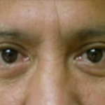 Blepharoplasty Before & After Patient #737