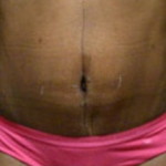Abdominoplasty Before & After Patient #784