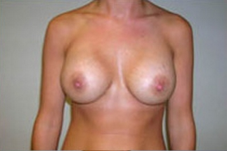 Breast Augmentation Before & After Patient #373