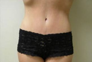 Abdominoplasty Before & After Patient #841