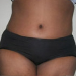 Abdominoplasty Before & After Patient #845