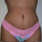 Abdominoplasty Before & After Patient #846