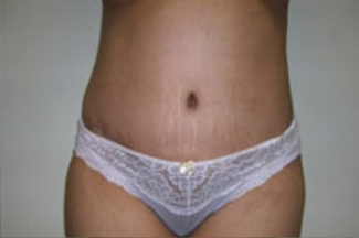 Abdominoplasty Before & After Patient #848