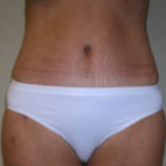Abdominoplasty Before & After Patient #891