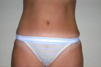 Abdominoplasty Before & After Patient #893