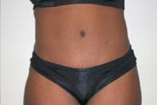 Abdominoplasty Before & After Patient #894