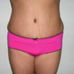 Abdominoplasty Before & After Patient #895