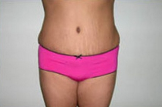 Abdominoplasty Before & After Patient #895