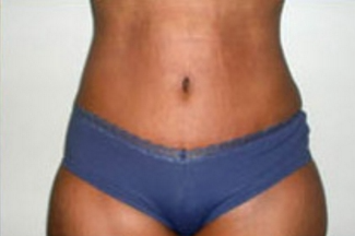 Abdominoplasty Before & After Patient #896
