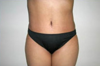 Abdominoplasty Before & After Patient #897