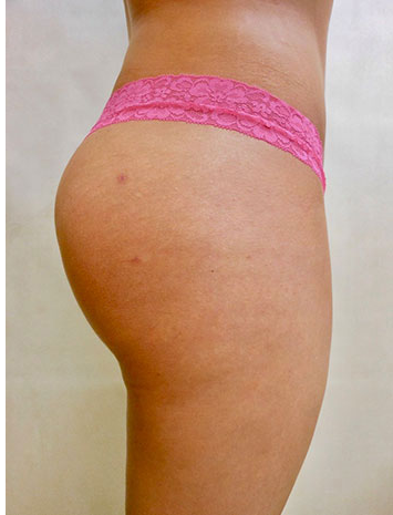 Brazilian Butt Lift Before & After Patient #1224