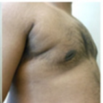 Gynecomastia Before & After Patient #549